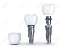 Implante Dental 3.5mm